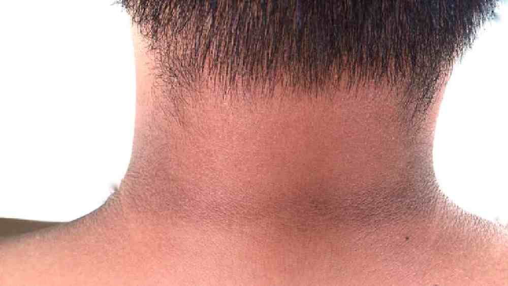 মেলানিনের পরিমাণ অসম ভাবে বেড়ে গেলেই এই ধরনের দাগ দেখা যায়।