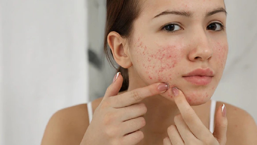 এমন অনেক বিষয় রয়েছে যেগুলি নীরবে বাড়িয়ে দিতে পারে ব্রণর সমস্যা।