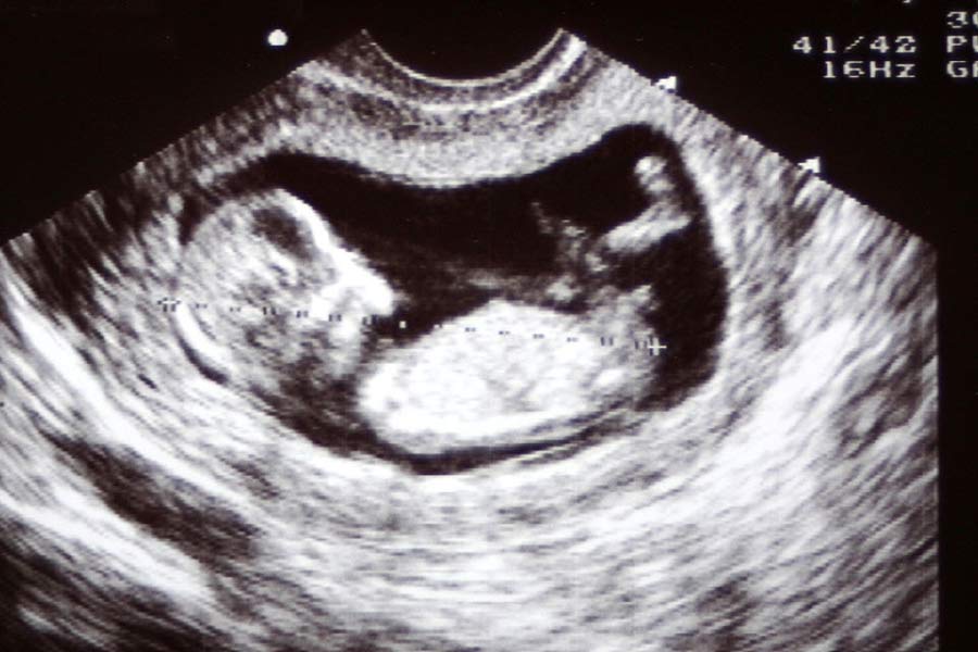 এ দিকে ছয় মাসের ভ্রূণ নাবালিকার গর্ভে। অগস্ট মাসে যখন ধর্ষণের কথা প্রকাশ্যে আসে তখন ইতিমধ্যেই সে ১৮ সপ্তাহের অন্তঃসত্ত্বা। চিকিৎসকদের কাছে গর্ভপাতের অনুরোধ জানিয়ে নাবালিকাকে কৌশাম্বী হাসপাতালে ভর্তি করেন তার বাবা।