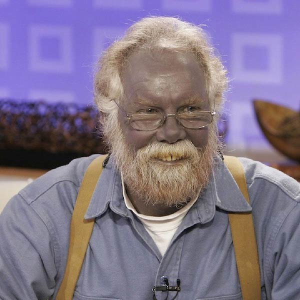 Blue Skin | American Man turns into blue after taking dietary ...