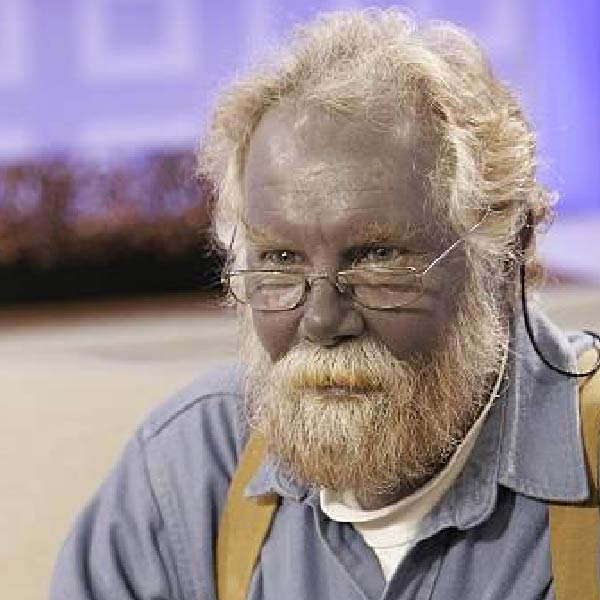 বেশ কিছু সংবাদমাধ্যমে প্রকাশিত খবর অনুযায়ী, পল কারাসন ডার্মাটাইটিসে ভুগছিলেন। ত্বকের সমস্যার সমাধান খুঁজছিলেন তিনি। কিন্তু এর মধ্যে সংক্রমণ ছড়িয়ে যায় সারা শরীরে।