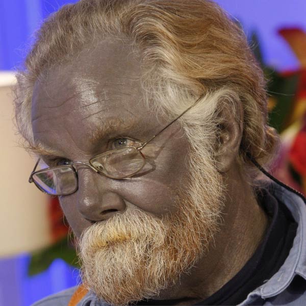 গায়ের রং বদলে যাওয়া এমন অসুখের নাম আছে কিছু? চিকিৎসকেরা জানাচ্ছেন, এই অসুখের নাম আর্জিরিয়া।