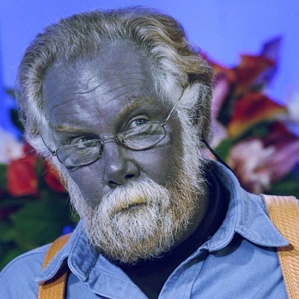 বেশ কিছু শারীরিক সমস্যায় ভুগছিলেন পল। চিকিৎসকের পরামর্শ নিয়েছিলেন। কিন্তু তার পর ইচ্ছে মতো পেশিবর্ধক খাবার খাওয়া শুরু করেন। আর তাতেই বদলে যায় তাঁর ত্বকের রং! সাপ্লিমেন্টের পার্শ্বপ্রতিক্রিয়ায় এখন তিনি ‘নীল মানুষ’।