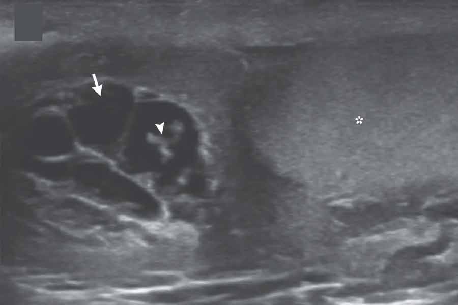 ‘ফাইলেরিয়াল ডান্স’ সঙ্কেতের সেই ছবি।