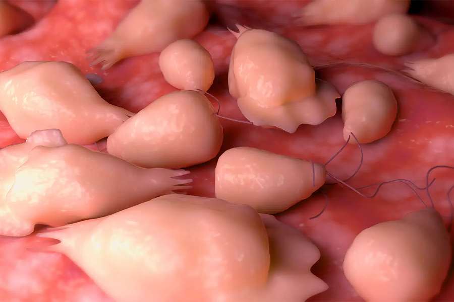 এর আগে এই রোগের কথা জানা গেলেও সাম্প্রতিক অতীতে এর কারণে কারও মৃত্যু হয়নি। তবে ময়নাতদন্তের রিপোর্ট বলছে, এ রোগ সংক্রমিত হতে পারে। হতে পারে মৃত্যুও।