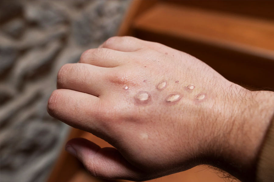 ১৪ জুলাই: ভারতে মাঙ্কি পক্সের প্রথম সংক্রমণ চিহ্নিত হল কেরলে। পশ্চিম এশিয়া থেকে ফেরা এক যুবকের দেহে মাঙ্কি পক্স ভাইরাসের খোঁজ পেল পুণের ‘ন্যাশনাল ইনস্টিটিউট অব ভাইরোলজি’। 