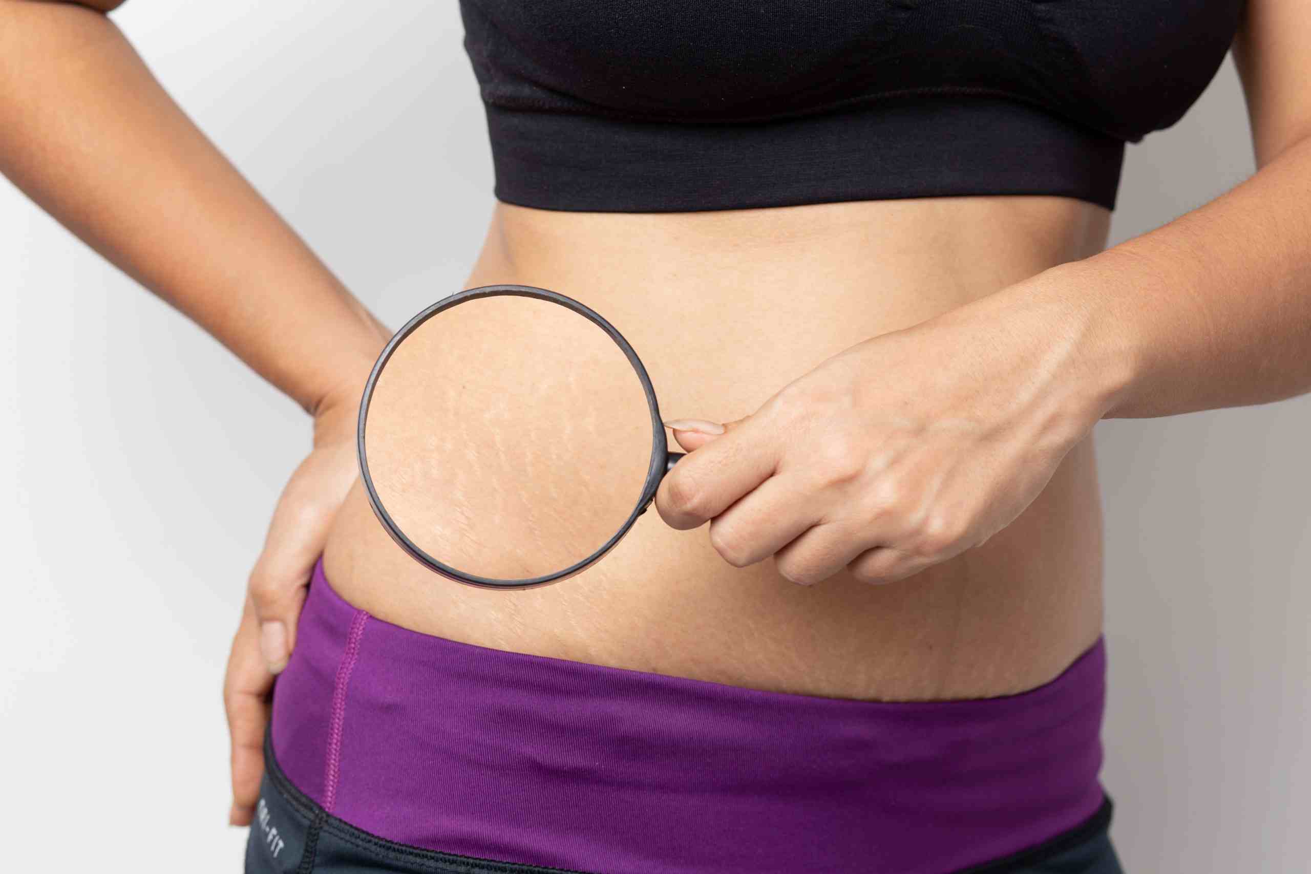 Know causes and tips to treat stretch marks