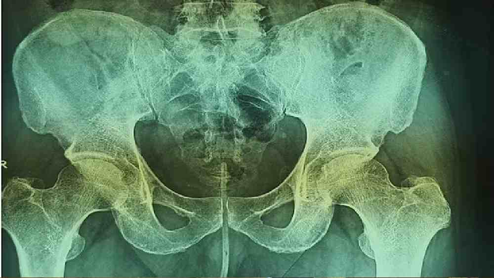 ওই ব্যক্তির এক্স-রে। 