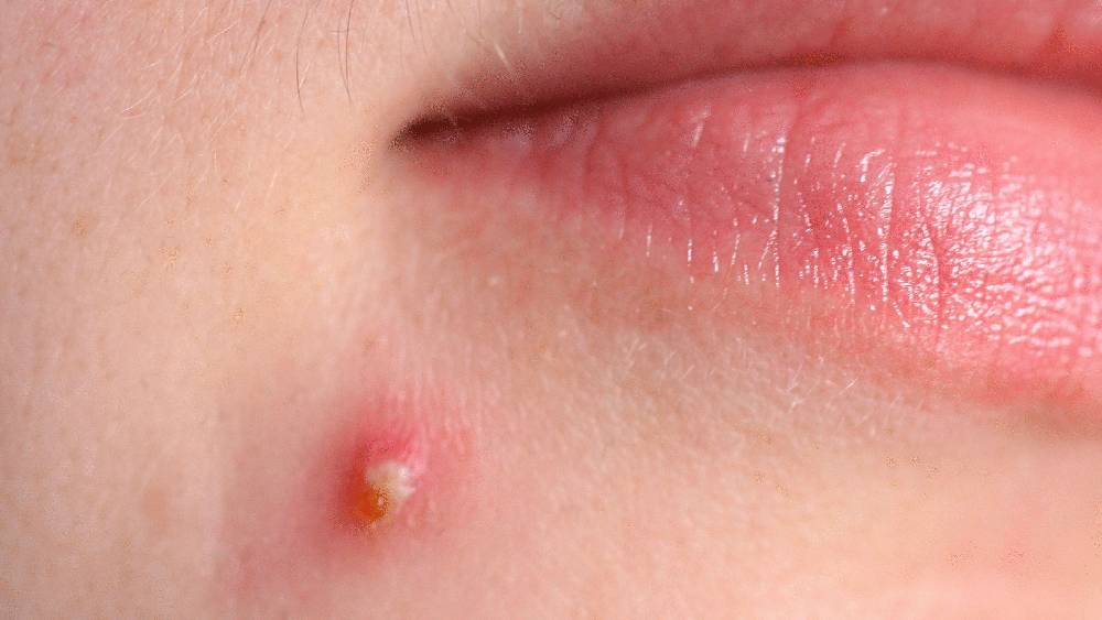 ডিম্বাশয়ে বেশি পরিমাণে অ্যান্ড্রোজেন তৈরি করে। তা থেকেই সিস্ট তৈরি হয় এবং তাতেই কপাল, গাল, চিবুক ব্রণয় ভরে যায়।