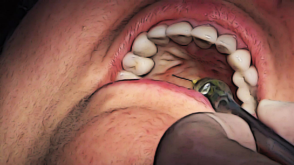 অবশেষে সেই সুযোগও পেয়ে গেলেন। হাসপাতাল থেকে বাড়ি ফেরার সময় বীরু জানান, তাঁর দাঁতে অসহ্য যন্ত্রণা করছে। সুনীল তাঁকে বাড়ির ভিতর আসতে বলেন এবং ব্যথা কমানোর জন্য ইনজেকশন দেন।