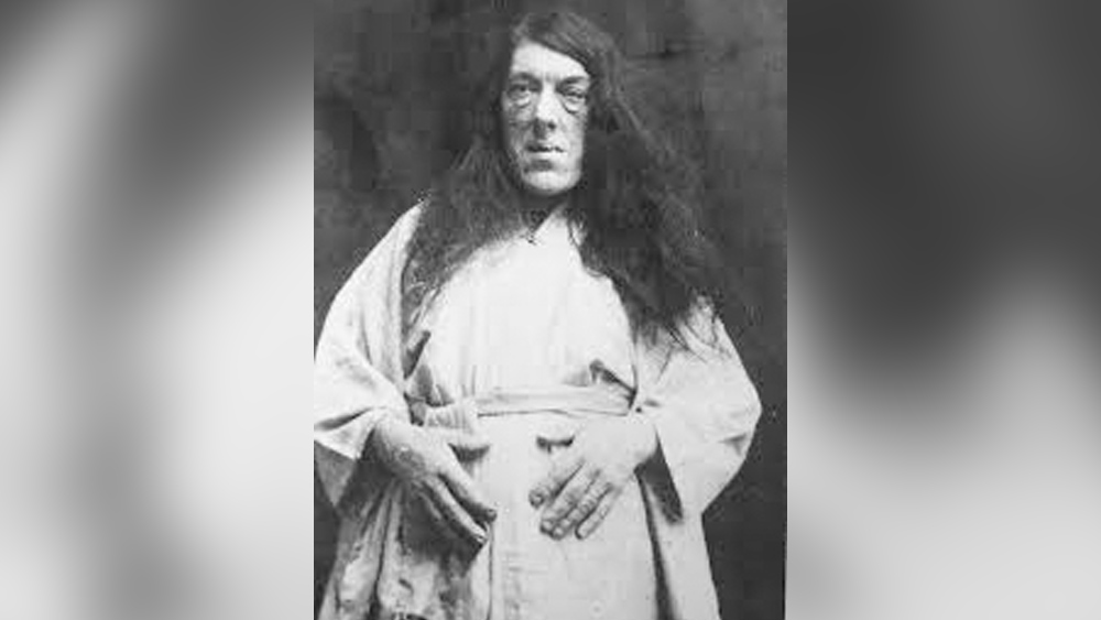 মাইগ্রেন বা গাঁটে ব্যথার সঙ্গে এ বার আরও একটি সমস্যা শুরু হয়েছিল। মুখের হাড়গোড় অস্বাভাবিক ভাবে বাড়তে শুরু করেছে। ফলে ধীরে ধীরে মুখ বিকৃতও হতে থাকে মেরি অ্যানের। কম বয়সেই তাঁর চেহারা বদলে গিয়েছিল। সংসারের চাপে নুইয়ে পড়া মহিলাদের তো এ রকম ‘ঘরোয়া’ চেহারাই দেখা যায়—অনেকে এমন বলেছিলেন।