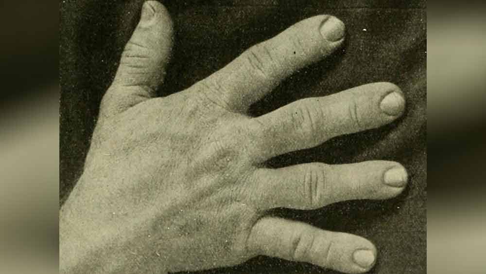 আধুনিক বিজ্ঞানে এই সমস্যাকে কাটিয়ে উঠা সম্ভব। তবে প্রায় দেড়শো বছর আগে ‘অ্যাক্রোমেগ্যালি’-র সমস্যার বিশেষ চিকিৎসা ছিল না। ফলে ধীরে ধীরে স্বাভাবিক মুখাবয়ব হারিয়ে ফেলতে শুরু করেন মেরি অ্যান।