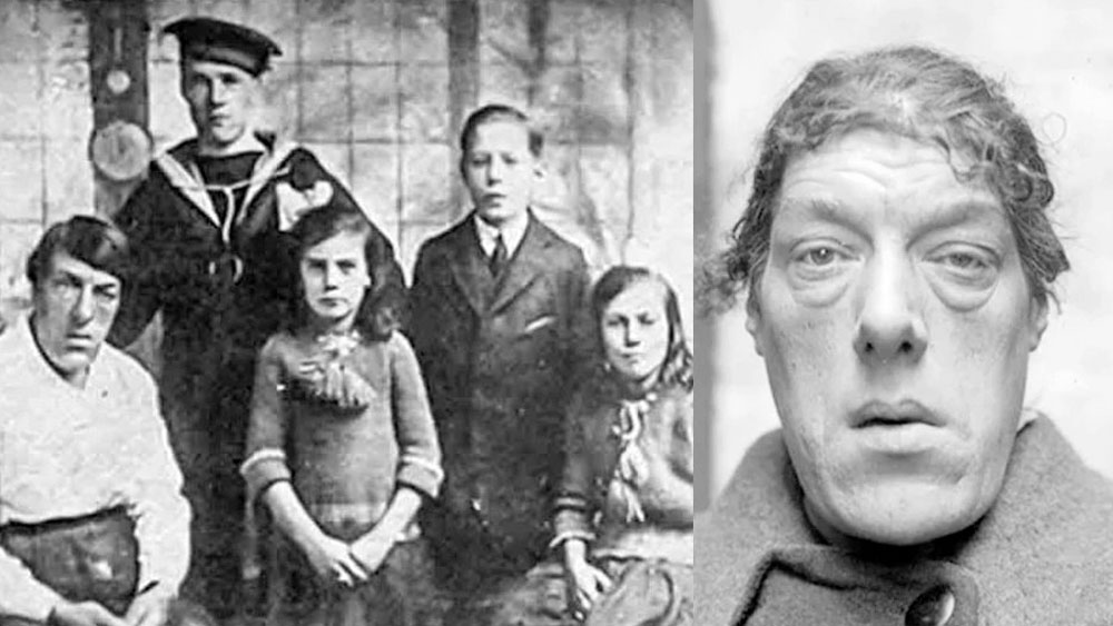 এরই মাঝে হঠাৎই ছন্দপতন। বিয়ের ১১ বছরের মাথায় মারা যান মেরি অ্যানের স্বামী টমাস। চার সন্তানকে নিয়ে অথৈ জলে পড়েন তিনি। সংসার চালাতে আবারও রোজগারের খোঁজে নেমে পড়েন। তবে মেরি অ্যানের মুখের দিকে চেয়ে কেউ তাঁকে কাজ দিতে রাজি নন। উল্টে অপমান করে তাড়িয়ে দেন অথবা ঠাট্টাতামাসা করেন। দিন কাটানোই সঙ্গিন হয়ে ওঠে মেরি অ্যানের।