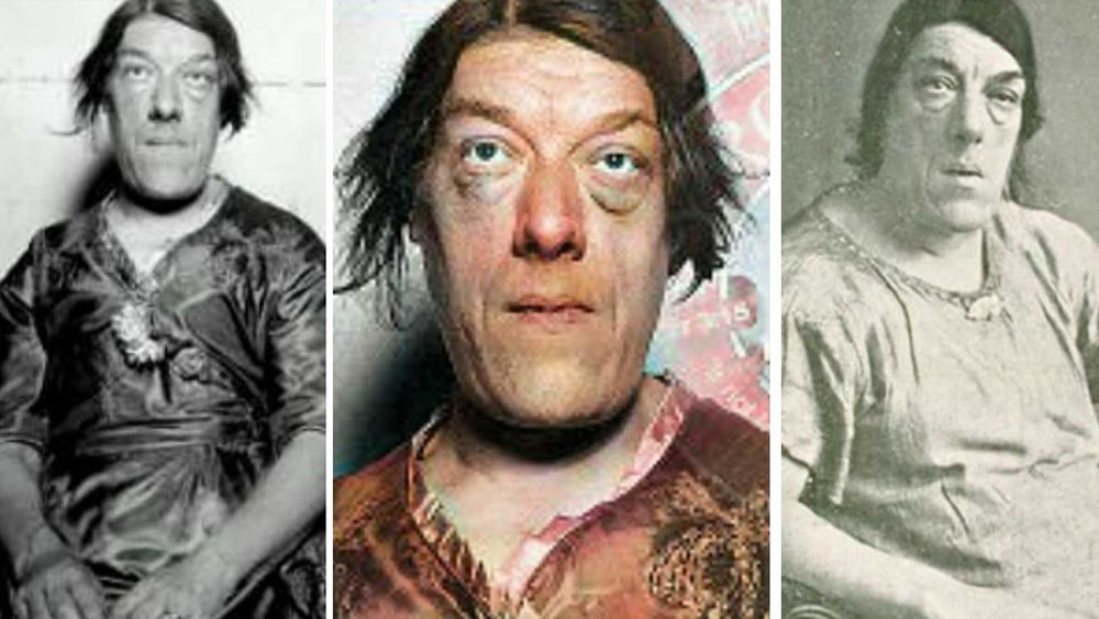 সংসার চালাতে এ বার দুনিয়ার ‘কুৎসিততম’ মহিলার খেতাবকেই হাতিয়ার করে ফেলেন মেরি অ্যান। ১৯২০ সালে আমেরিকার সার্কাসে কাজের ডাক পান মেরি অ্যান। তাঁবু খাটানো মঞ্চে উঠে সকলকে হাসাতে হবে। যেমনটা সার্কাসের জোকাররা করেন। অথবা সায়ামিজ যমজ বা দৈত্যাকার মানুষদের দেখে হাসি লুঠতে ভিড় করেন মানুষজন। সঙ্গে সঙ্গে রাজি মেরি অ্যান। ইংল্যান্ডের জীবন ছেড়ে আমেরিকা পাড়ি দেন তিনি।