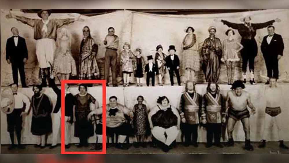 মেরি অ্যানকে নিয়ে ঠাট্টাতামাশার বিরুদ্ধে এক সময় সরব হয়েছিলেন  চিকিৎসকেরা। তিনি যে ‘অ্যাক্রোমেগ্যালি’-র সমস্যায় ভুগছেন, তা কোনও ভাবে প্রকাশ্যে চলে আসে। ১৯২৭ সালে সে সময়কার এক স্নায়ুরোগ বিশেষজ্ঞ হার্ভি কাসিং চিঠি লিখে প্রতিবাদ জানান। মেরি অ্যানের চেহারাকে যে ভাবে হাসির খোরাক করে তোলা হয়েছে, তার বিরুদ্ধে সরব হয়েছিলেন হার্ভি। তবে প্রতিবাদ সত্ত্বেও সার্কাসে মেরি অ্যানের শো বন্ধ হয়নি।