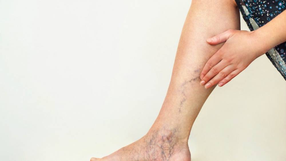 Surprising home remedies to get rid of problems related to varicose veins dgtl