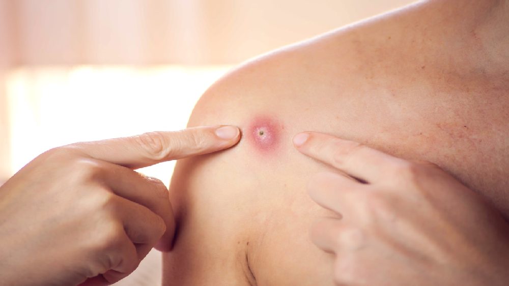  ফোস্কার মতো অসংখ্য ক্ষতচিহ্নের দেখা মেলে শরীরে। 