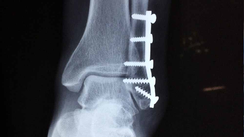 এ বার স্ক্রু-টিকে তথ্য হিসাবে কাজে লাগাতে শুরু করেন তদন্তকারীরা। খোঁজখবর নিয়ে জানা যায়, পিটকার আদতে পুণের সংস্থা। অস্থির অস্ত্রোপচারের জন্য দেশ জুড়েই এ ধরনের স্ক্রু সরবরাহ করে তারা। 