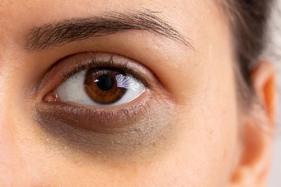 কাঠবাদামের তেল চোখের তলার কালচে ভাব দূর করতে সাহায্য করে।