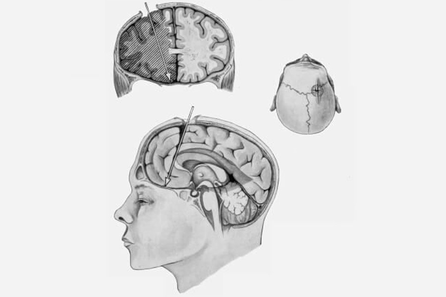 দ্বিতীয় বিশ্বযুদ্ধের সময়কালে মানসিক রোগ বা সমস্যা নিয়ে বিশেষ ওয়াকিবহাল ছিল না চিকিৎসক মহল। অভিযোগ, সে সময় এরিক স্টর্মগ্রেন এবং লারুস আইনারসন নামে দু’জন তরুণ চিকিৎসক মানসিক রোগীদের মস্তিষ্ক হাতানোর ছক কষেছিলেন। ময়নাতদন্তের সময় তাঁদের মস্তিষ্ক সরিয়ে নিতেন তাঁরা। এর পর তা গোপন জায়গায় জমা করে রাখতেন। যদিও কী উদ্দেশ্যে দুই চিকিৎসক এমন করতেন, তা জানা যায়নি।