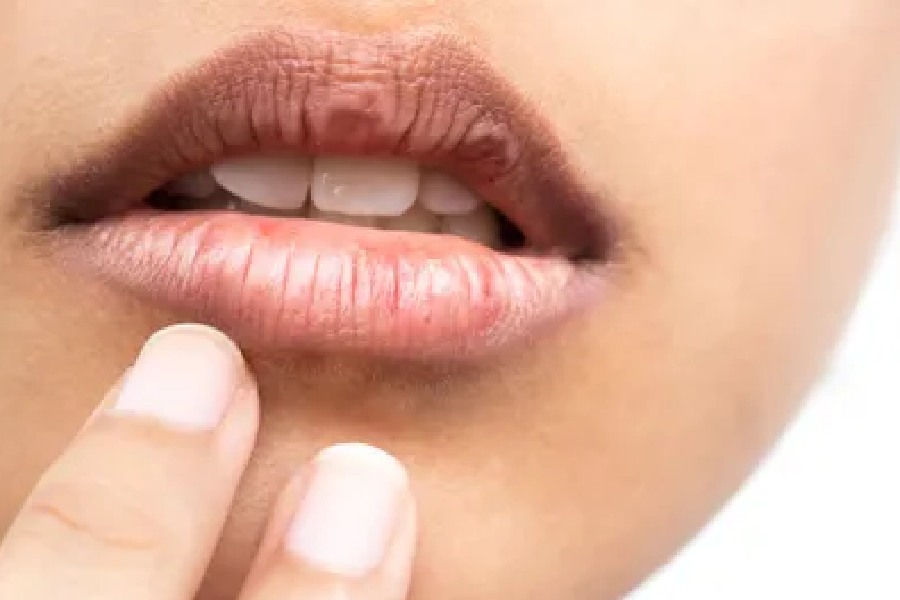 ঠোঁট শুষ্ক হয়ে গেলেও কালো ছোপ পড়তে পারে।