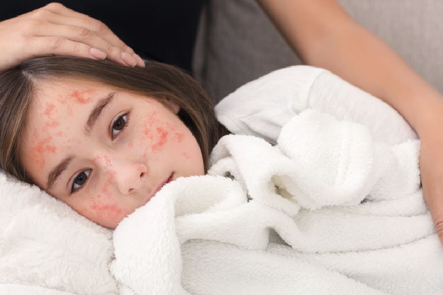 প্রাথমিক ভাবে হাম হলে জ্বর, সর্দি, হাঁচি, চোখ লাল হওয়া, কিছু ক্ষেত্রে চোখের পাতা ফুলে যাওয়া, সারা শরীরে তীব্র ব্যথা দেখা যায়।