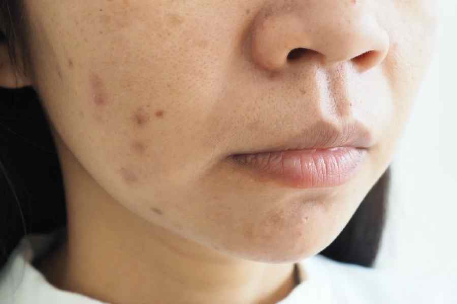 চর্মরোগ চিকিৎসকরা জানাচ্ছেন, আসলে অনেকেই বুঝতে পারেন না কোনটা ব্রণ-পরবর্তী দাগ আর কোনটা ব্রণর চিহ্ন। 