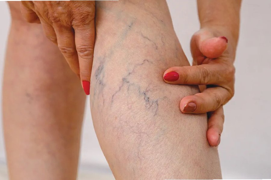 যাঁরা অনেক ক্ষণ দাঁড়িয়ে কাজ করেন, তাঁদের পায়ে এই ধরনের রক্ত জালিকা দেখা যায়।