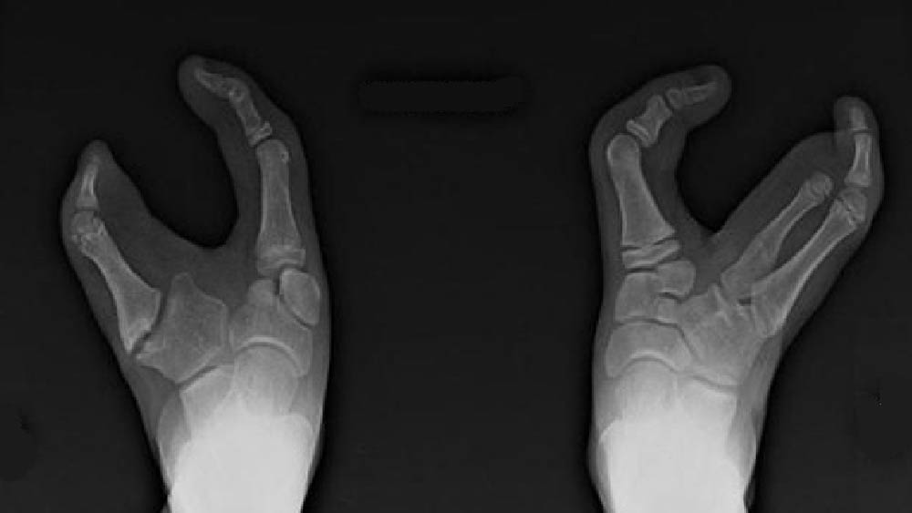 জিনগত কারণেই এই উপজাতি গোষ্ঠীতে জন্ম নেওয়া প্রতি চার জন শিশুর এক জনের পায়ের আঙুল দু’টি। এঁদের পায়ে বৃদ্ধাঙ্গুষ্ঠ এবং কনিষ্ঠা বাদে মাঝের তিনটি আঙুল অনুপস্থিত।