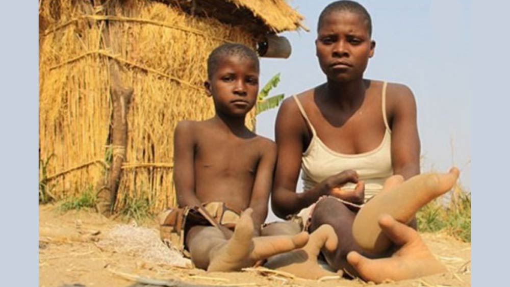 ভাদোমা উপজাতির মানুষদের যে দু’টি আঙুল আছে, সেগুলিও ভিতর দিকে ঢোকানো। পায়ের আকৃতি অনেকটা উটপাখি বা অস্ট্রিচের মতো। তাই অনেকেই এঁদের ‘অস্ট্রিচ পদবিশিষ্ট’ উপজাতি বলে থাকেন।