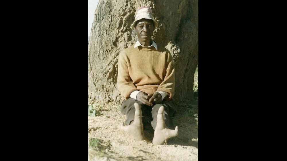 এই উপজাতির মানুষদের নিজের জনজাতি গোষ্ঠীর বাইরে বিয়ে করা নিষিদ্ধ। ফলে পায়ের আঙুলের এই বিরল গঠনগত বৈশিষ্ট অন্য কোনও গোষ্ঠীর মধ্যে ছড়িয়ে পড়েনি।