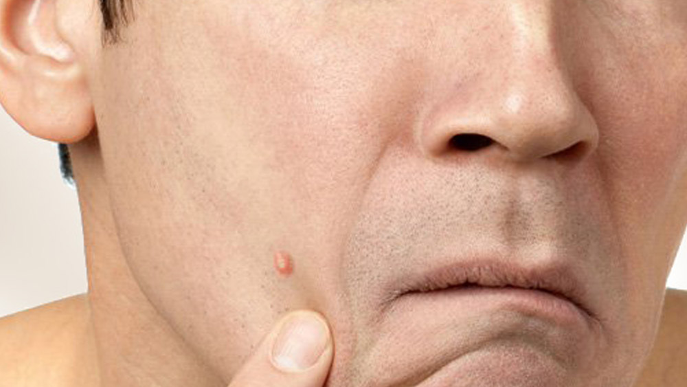 সকালে মুখে নিয়মিত সামান্য ফটকিরি লাগিয়ে জল দিয়ে ধুয়ে নিলেও উপকার পাওয়া যাবে। মুখে ব্রণ দেখা দিলেও তা কমে যাবে।