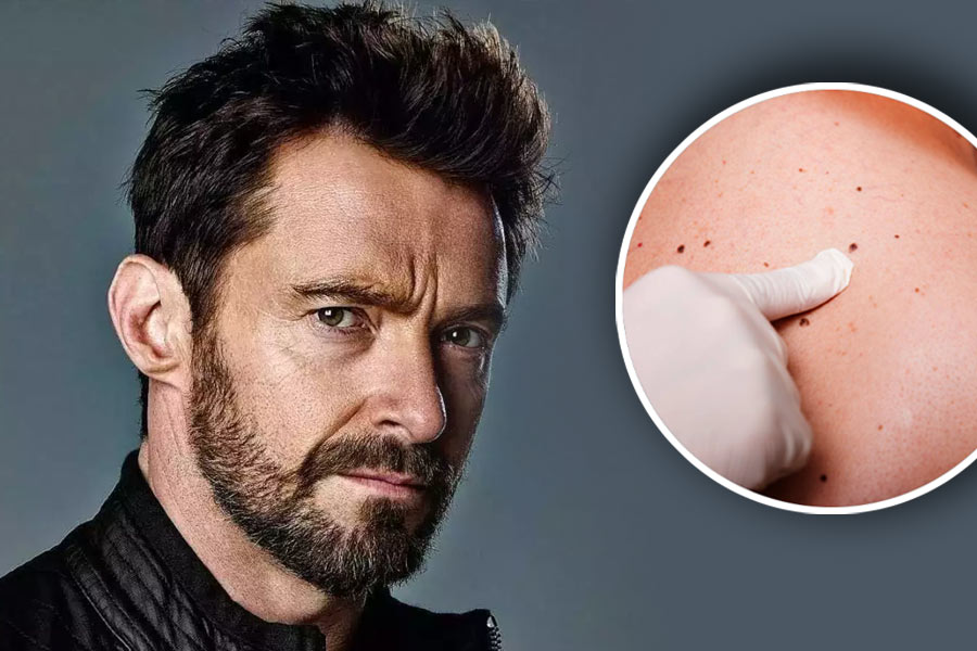 Hugh Jackman has new skin cancer scare, urges sun safety