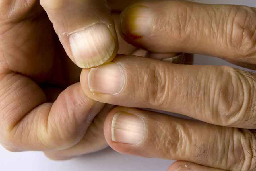 Know silent cancer symptom you can spot on your nails
