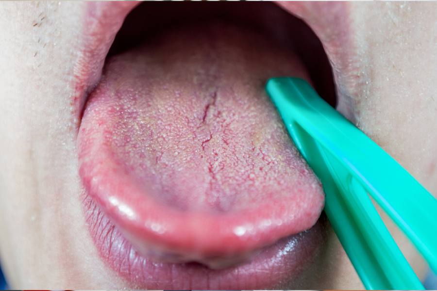 white-tongue-causes-causes-of-a-white-tongue-and-how-to-get-rid-of-it