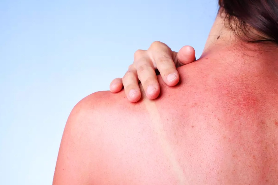 How to avoid getting sunburns in summer