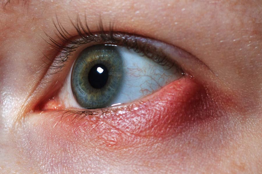image of styes