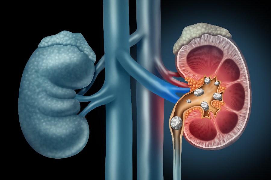 guidelines for kidney stone