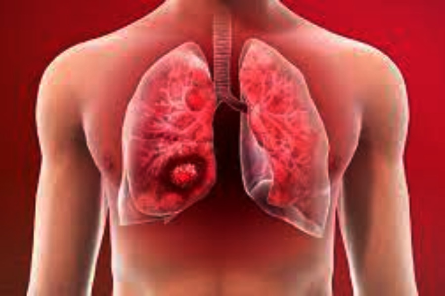  suffering from lung cancer