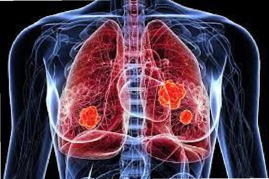 suffering from lung cancer