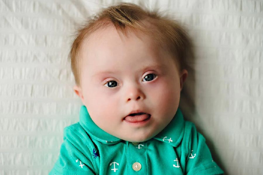 Facial changes in down syndrome