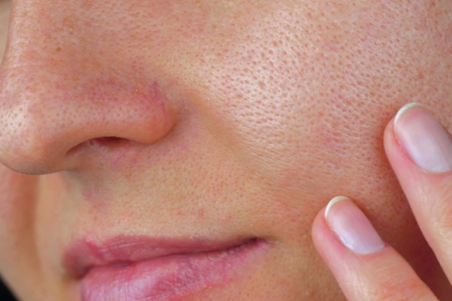 Image of open pores