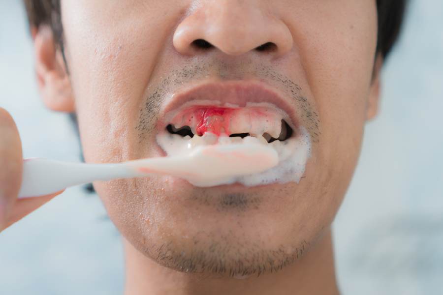 মাড়ির টিস্যুগুলির স্বাভাবিক কর্মক্ষমতা নষ্ট করে ধূপমান, কাজেই ধূমপায়ীদের আকছার মাড়ি থেকে রক্তপাত হয়। 