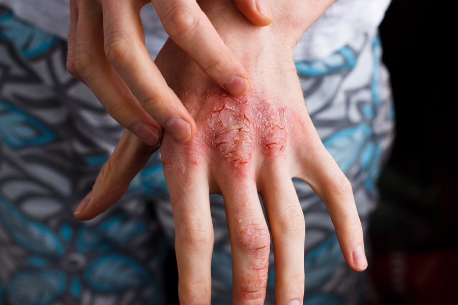 Can frequently washing hands cause eczema.