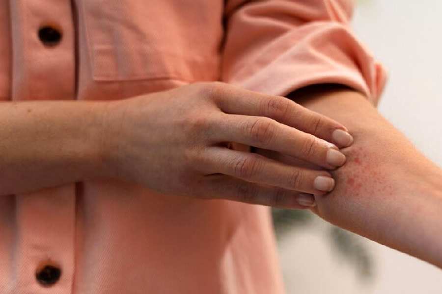 How to treat winter rash.