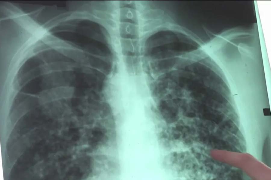 বিশেষজ্ঞদের ধারণা, মাইকোপ্লাজমা নিউমোনিয়া নামে এক ব্যাকটেরিয়ার সংক্রমণ ‘হোয়াইট লাং সিন্ড্রোম’ রোগের মূল কারণ। তবে এই রোগের আশঙ্কার মূল কারণ যে অ্যান্টিবায়োটিক খাওয়ার পরেও এই রোগ নিরাময় করা যাচ্ছে না। 