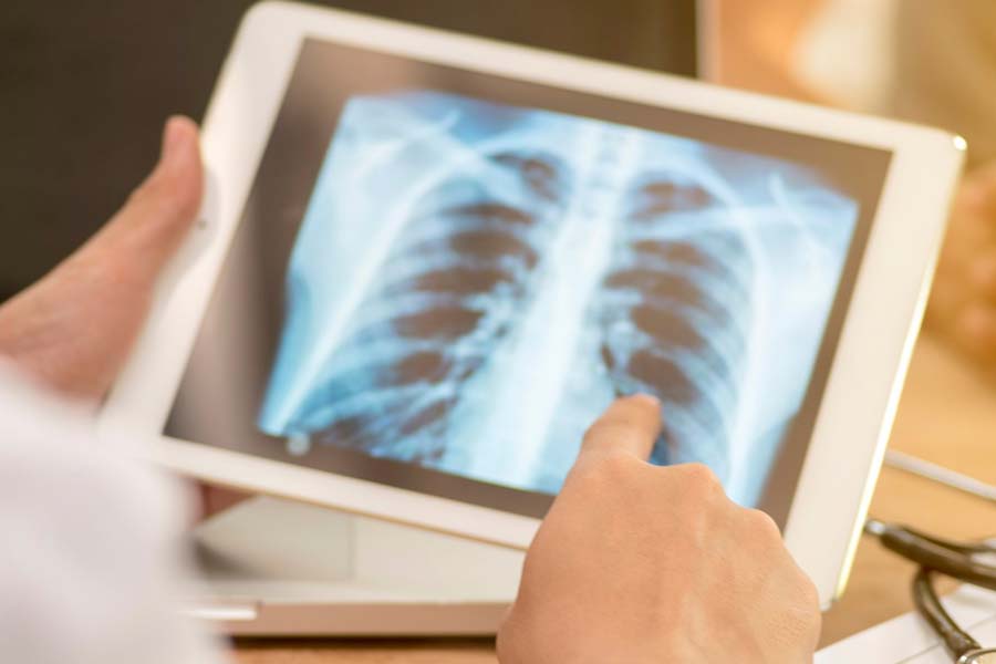 ডেনমার্কে পরিস্থিতি সবচেয়ে বিপজ্জনক। ‘হোয়াইট লাং সিনড্রোম’ সেখানে যেন এক ‘মহামারি’র চেহারা নিয়েছে বলে দাবি স্বাস্থ্য বিশেষজ্ঞদের। স্থানীয় স্বাস্থ্য প্রশাসনের বক্তব্য, এই মুহূর্তে সংক্রমণের যা ছবি ফুটে উঠেছে তার সঙ্গে করোনা সংক্রমণের আদিপর্বের মিল রয়েছে অনেকটাই। নেদারল্যান্ডসেও এই সন্দেহজনক ‘নিউমোনিয়া’য় আক্রান্ত শিশুর সংখ্যা বৃদ্ধি পেয়ে চলেছে বলে খবর। 