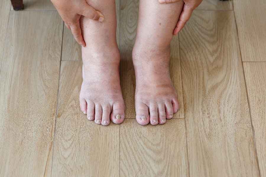 Image of Swelling Feet.
