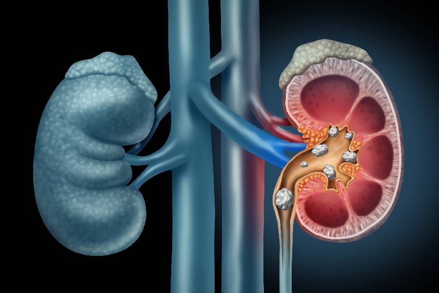 Can calcium supplements cause kidney stones.