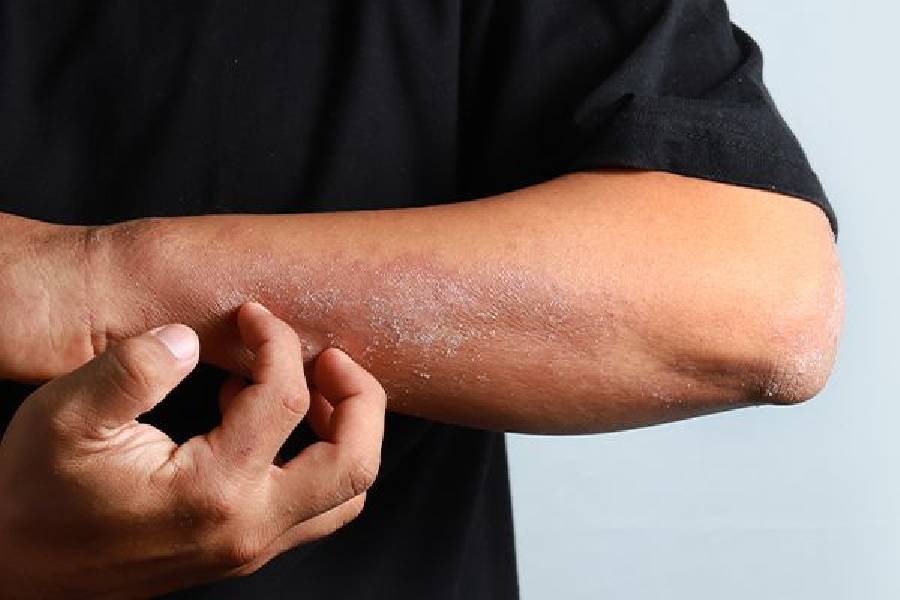 Three best natural remedies to treat itching and dry skin in winter.